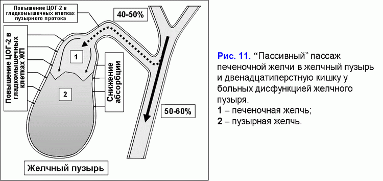 Негомогенный желчный пузырь