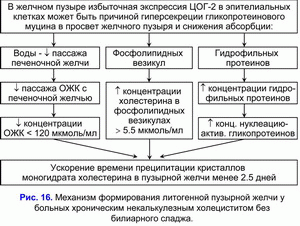 Формирование литогенной пузырной желчи, хронический некалькулезный холецестит без билиарного сладжа