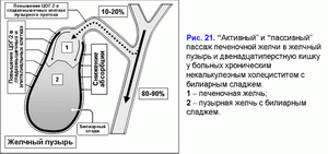 Активный и пассивный пассаж печеночной желчи, хронический некалькулезный холецестит, билиарный сладж