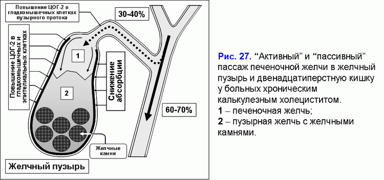 Доклад: Холецистит острое воспаление желчного пузыря