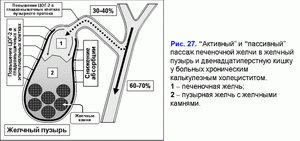 Активный и пассивный пассаж печеночной желчи, хронический калькулезный холецестит