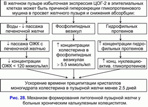 Формирование литогенной пузырной желчи, хронический калькулезный холецестит