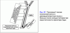 Постхолецистэктомический синдром, пассивный пассаж, недостаточность сфинктера Одди