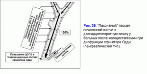 Постхолецистэктомический синдром, пассивный пассаж, дисфункция сфинктера Одди (панкреатический тип)