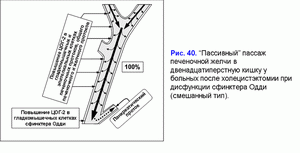 Постхолецистэктомический синдром, пассивный пассаж, дисфункция сфинктера Одди (смешанный тип)