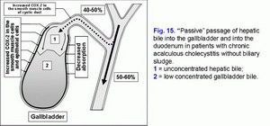 Passive passage of hepatic bile,chronic acalculous cholecystitis without biliary sludge