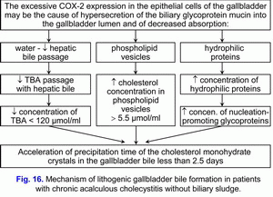 Lithogenic gallbladder bile formation, chronic acalculous cholecystitis without biliary sludge