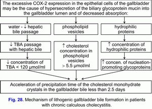 Lithogenic gallbladder bile formation, chronic calculous cholecystitis