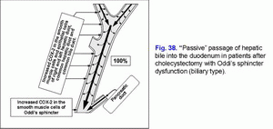 Passive passage of hepatic bile, Oddi's sphincter dysfunction (biliary type), cholecystectomy