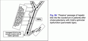 Passive passage of hepatic bile, Oddi's sphincter dysfunction (pancreatic type), cholecystectomy