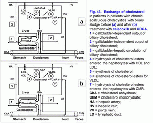 Exchange of cholesterol, chronic acalculus cholecystitis, biliary sludge