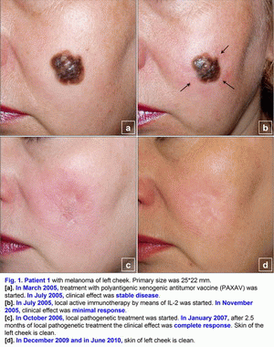 Melanoma, T4(?)N0M0, polyantigenic xenogenic antitumor vaccine