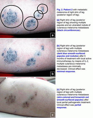 Melanoma, T3N0M0, polyantigenic xenogenic antitumor vaccine