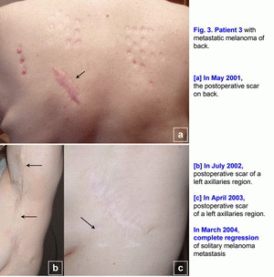 Melanoma,T2N0M0, polyantigenic xenogenic antitumor vaccine